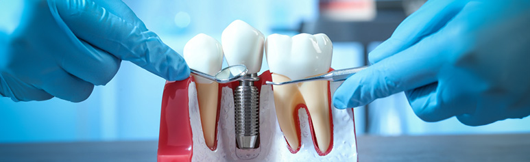 Top 5 Advantages of Dental Implants in London, According to Leading Dentists